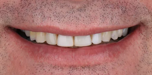 Antes - Desgaste por Bruxismo